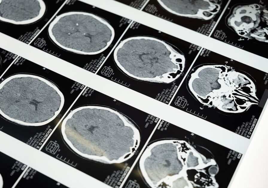 brain trauma motorcycle wreck santa ana